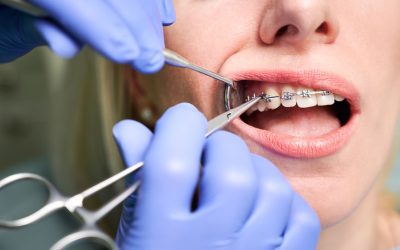 Is Orthodontics Cosmetic Dentistry? Exploring the Connection and Benefits
