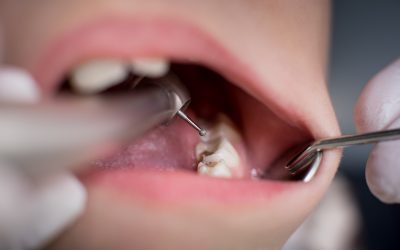 What is Endodontics? Exploring the Field of Root Canal Treatment