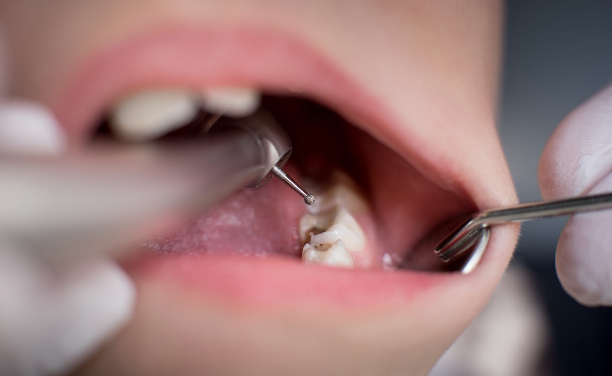 What is Endodontics - Golden Gate Dentists