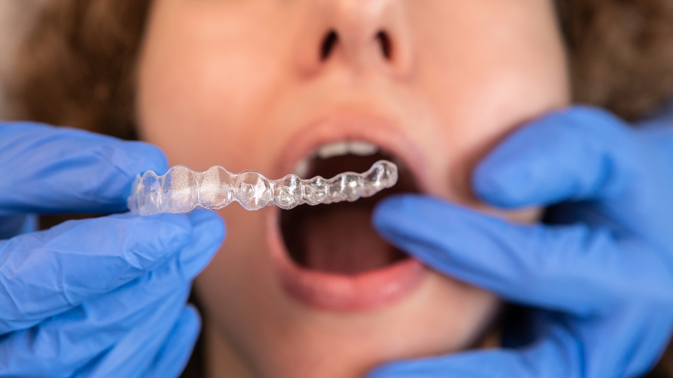 Can You Go to an Orthodontist Without a Referral - Golden Gate Dentists