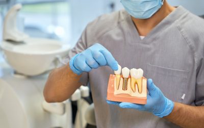 What Are the Pros and Cons of Dental Implants: A Concise Yet Detailed Overview