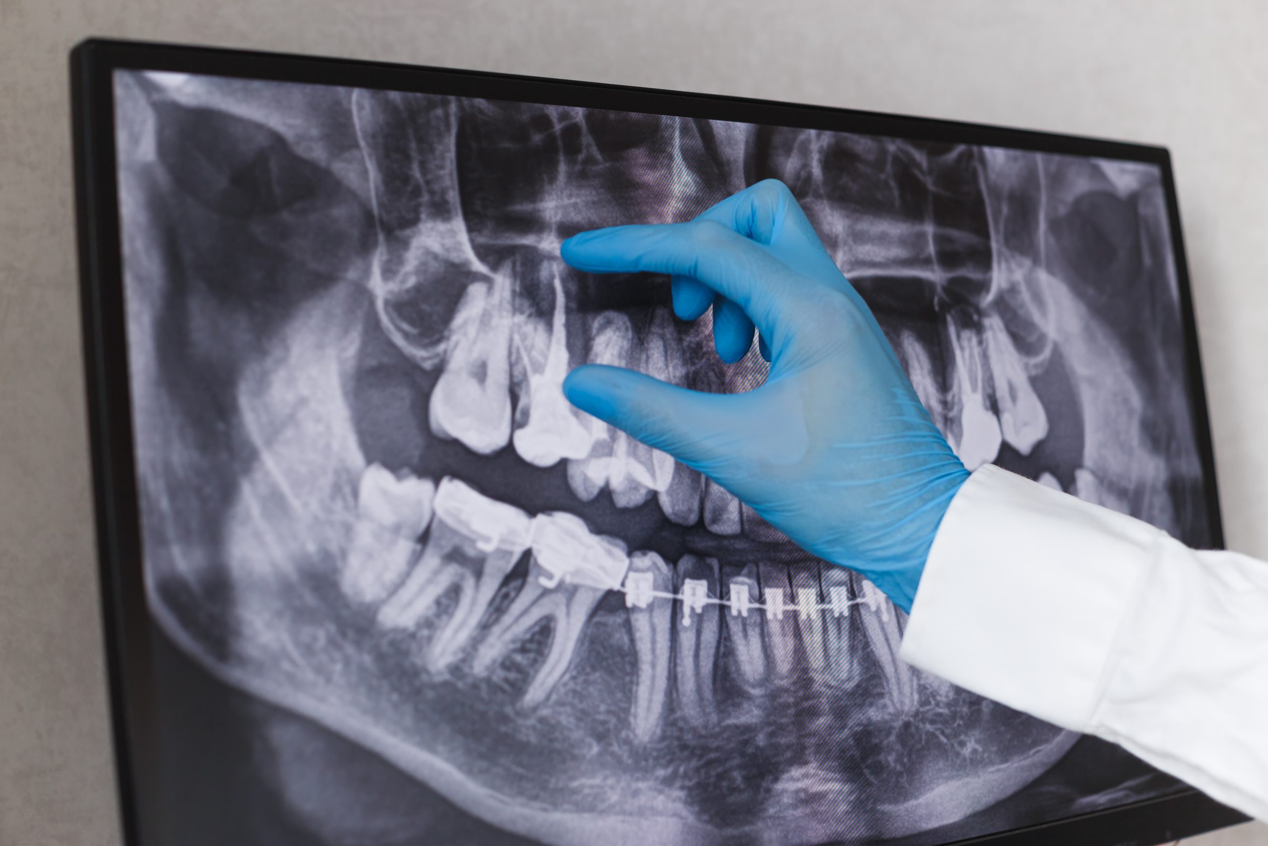 Difference Between a Dentist and an Endodontist - Golden Gate Dentists
